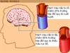 Biết và đề phòng Tai biến mạch máu não