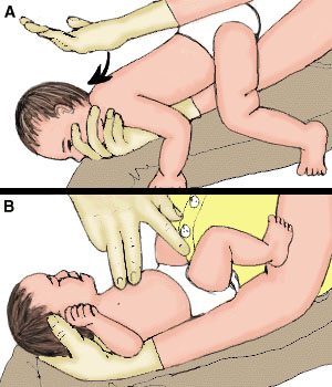 Xử trí trẻ hóc các loại hạt